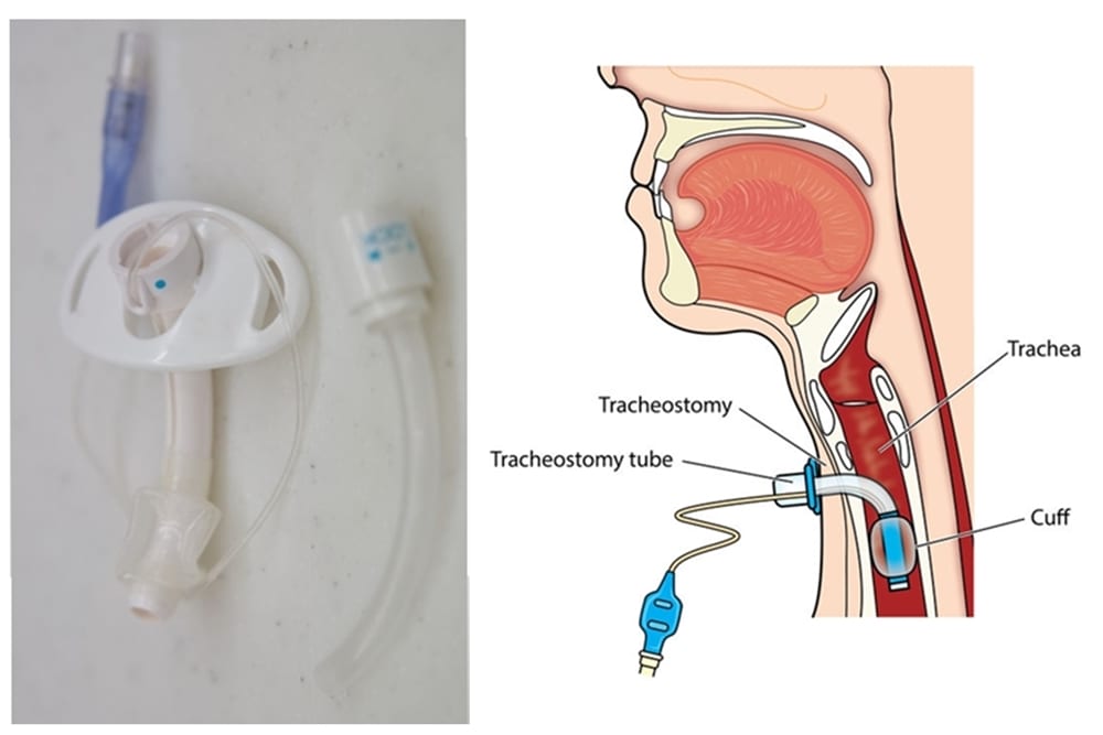 Image showing placement of a trache tube into the diagram and how the balloon is used to hold it in place as part of the tracheostomy care.