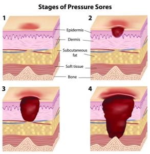 Four stages of pressure ulcers